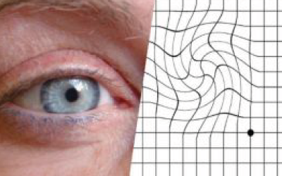 Essais pour le Brolucizumab