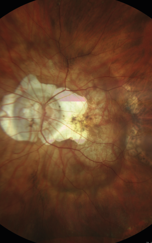 myopie_forte Myopie forte