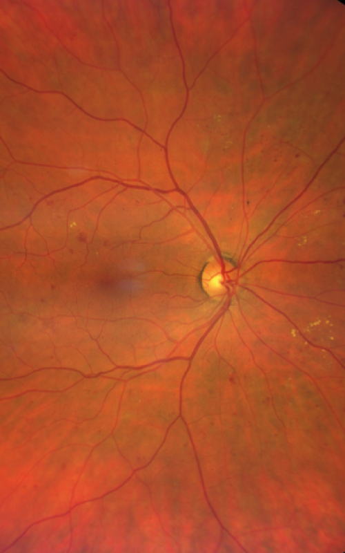 Retinopathie diabétique