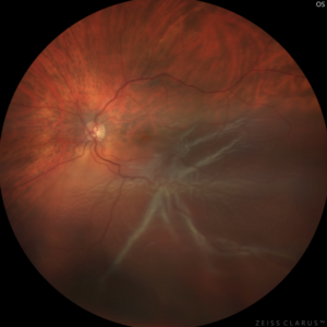 Diagnostic décollement de rétine