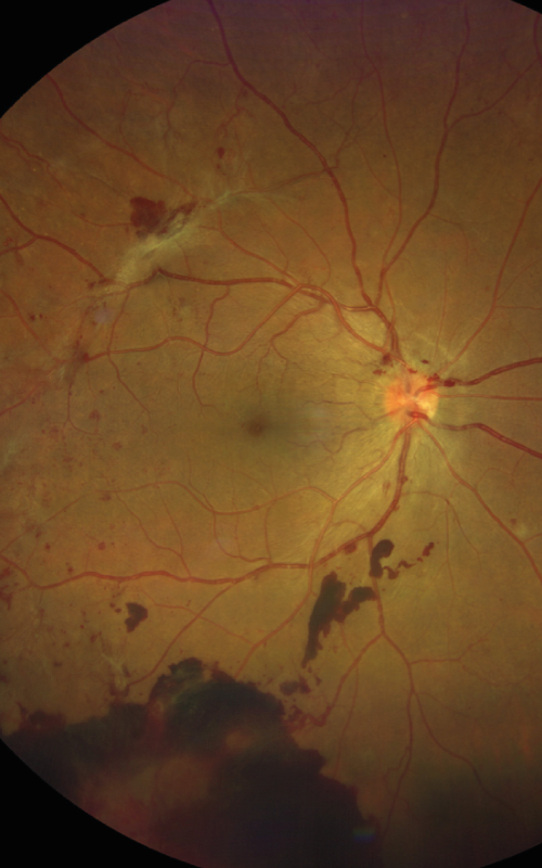 Rétinopathie diabétique