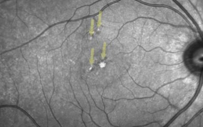 Cas Clinique – le danger invisible des pointeurs laser chez l’enfant