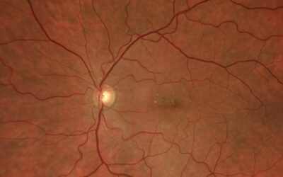 Cas Clinique – quand une CRSC se complique…