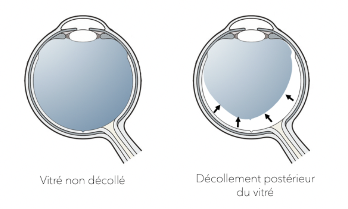 Définition du décollement postérieur du vitré 