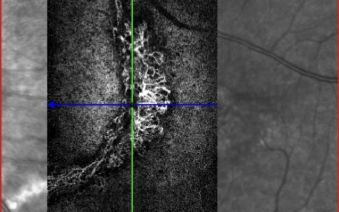Traumatisme oculaire au padel : quand l’acuité visuelle à 10/10 cache une complication à retardement.