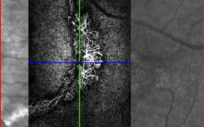 Traumatisme oculaire au padel : quand l’acuité visuelle à 10/10 cache une complication à retardement.